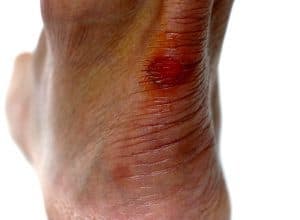 painful blister from hiking