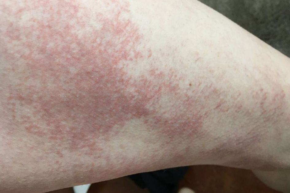 Disney rash