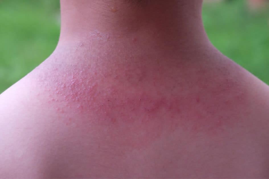 hiker's rash